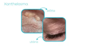Jett Plasma - kezelés - Xanthelasma 